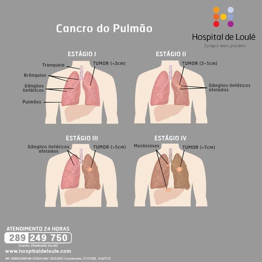 Cancro do Pulmão: fique atento aos sinais