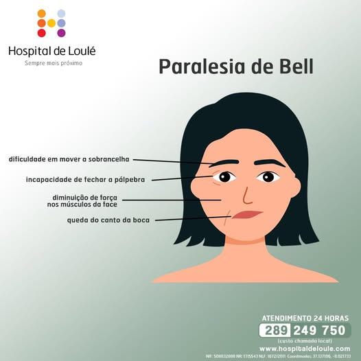 Do you know what Bell's Palsy is?